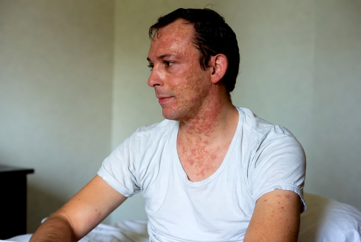 measles-outbreak-continues-to-spread-bringing-echoes-of-the-pandemic